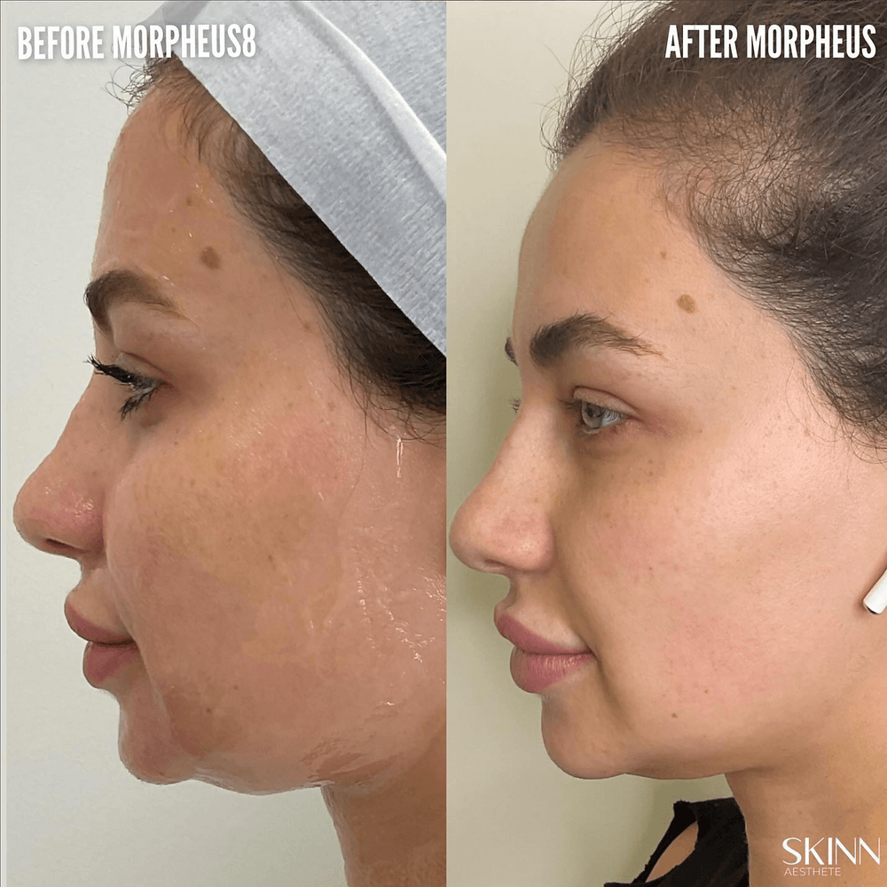 Before and after Morpheus8 results