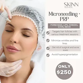 Microneedling and PRP treatment promotional image.